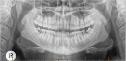 Impacted lower wisdom teeth that have caused irrepairable damage to the second molar teeth