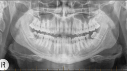 Impacted lower wisdom teeth that have caused irrepairable damage to the second molar teeth