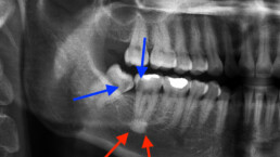 Dentoalveolar Surgery brisbane Dr Joel Tuckett