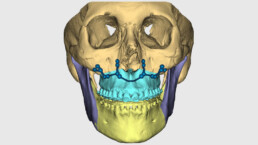 Orthognathic Surgery