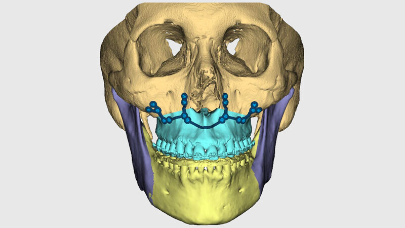Orthognathic Surgery