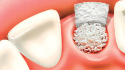 Bone Grafting surgery